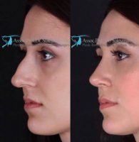 Closed Atraumatic Rhinoplasty Before and After