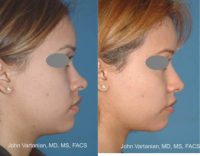18-24 year old woman treated with Rhinoplasty and nasal implant