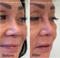 55-64 year old woman treated with Nonsurgical Nose Job