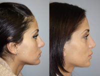 25 Year Old Female presents for Revision Rhinoplasty