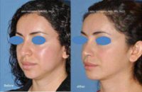 Patient treated with Closed (scarless) rhinoplasty and chin implant