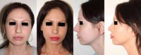 before and after rhinoplasty photos
