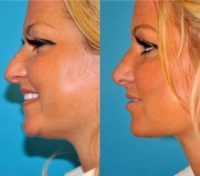 Woman treated with Chin Implant