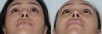 35 year old woman treated with Revision Rhinoplasty