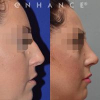 Woman treated with Rhinoplasty