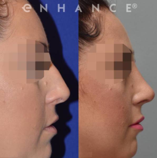 Dr Charles S Lee Md Facs Beverly Hills California Lady Treated With Cosmetic Rhinoplasty 1264