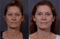45-51 year old woman treated with Facelift