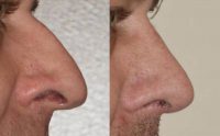 45-54 year old man treated with Rhinoplasty