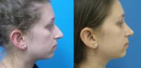 25 year old  -  Rhinoplasty/Septoplasty/Partial Turbinectomy  -  7 months post-op