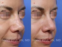 35-44 year old Caucasian woman treated with Revision Rhinoplasty