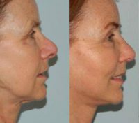 55-64 year old woman treated with Mini Lift and Rhinoplasty
