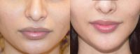 Chin Augmentation Done by Dr Monisha Kapoor