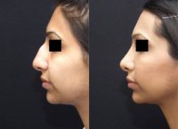 25-34 year old woman treated with Rhinoplasty