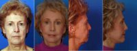 Facelift/necklift with Revision Rhinoplasty and CO2 Laser Resurfacing