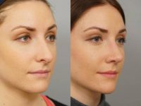 Rhinoplasty performed on 23 year old woman to reduce bump
