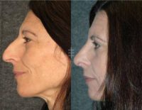 48 year old woman treated with Rhinoplasty