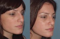 25-34 year old woman treated with Rhinoplasty, Septoplasty and Endoscopic Sinus Surgery