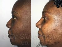 Woman treated with Rhinoplasty