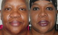 Woman treated with African American Rhinoplasty
