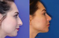 25-34 year old woman treated with Open Rhinoplasty