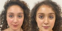 21 year-old woman treated with Rhinoplasty