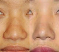Asian plastic surgery, Rhinoplasty