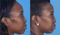 35-44 year old woman treated with African American Rhinoplasty