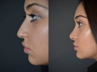 19 year old woman treated with Rhinoplasty