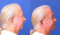 Face neck lift with platysmaplasty and Chin Augmentation & Rhinoplasty