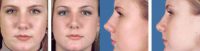 Rhinoplasty front and side view