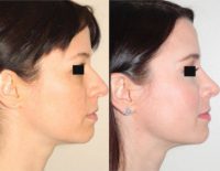 Open Rhinoplasty - Before and After