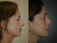 Open rhinoplasty with complete division of domes to reduce tip width.