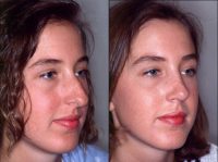 Rhinoplasty to correct multiple issues