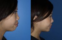 Revision Rhinoplasty with Chin Implant