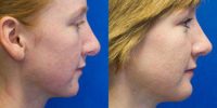 Revision rhinoplasty combined with silicone chin implantation