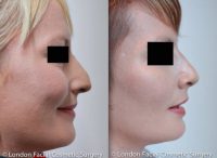 Rhinoplasty/ Nose Re-Shaping Case: Review Before & After Photograph