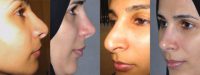 Second Revision for 2 failed rhinoplasties by other surgeons. Complete reconstruction Nosejob