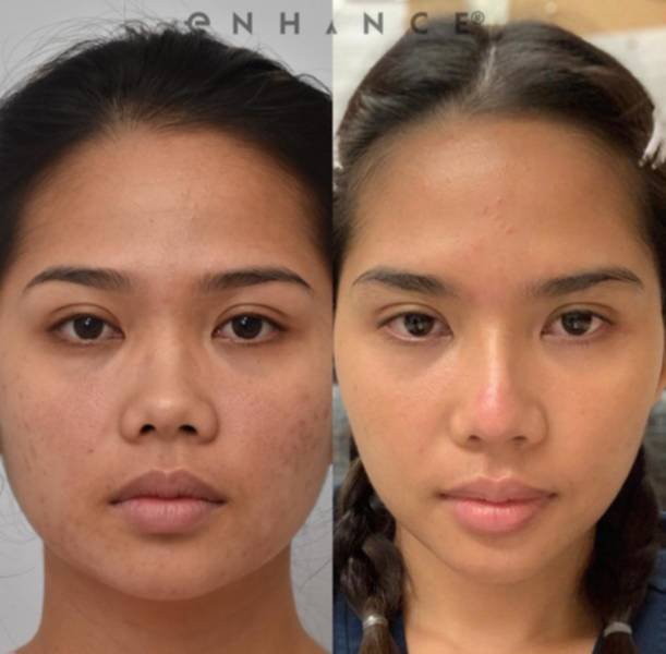 Spouse Treated With Aesthetic Nose Surgery With Dr Charles S Lee Md Facs Beverly Hills