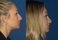 Rhinoplasty for young man