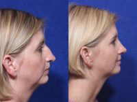 Rhinoplasty-1 year result