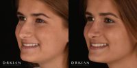 Teen Rhinoplasty Before & After One Year by Dr. Kian Karimi