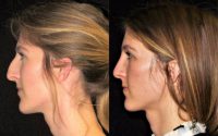 This patient is shown 5 months after a closed rhinoplasty