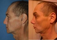 Transgender FFS Facial Feminization Rhinoplasty, Lip Enhancement VY Advancement