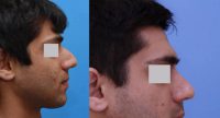 young old man treated with Rhinoplasty