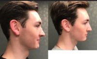 18-24 year old man treated with Nonsurgical Nose Job
