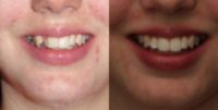 18-24 year old woman treated with Six Month Smiles