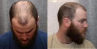 25-34 year old man treated with ARTAS Robotic Hair Transplant
