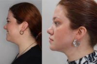 27 y/o woman treated with Liposuction + Renuvion