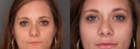 25-34 year old woman treated with Injectable Lip Fillers