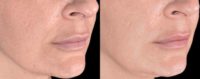25-34 year old woman treated Bellafill for acne scarring and nasolabial folds